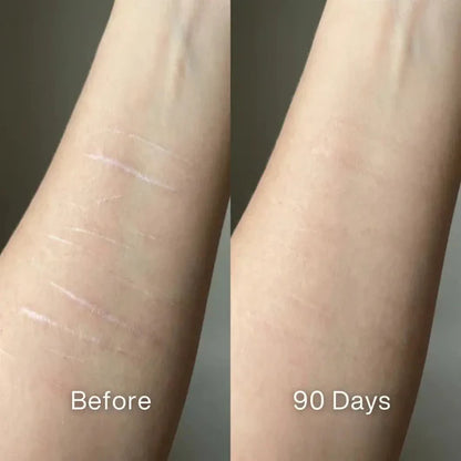 Scar Renewal - Advanced Medical Silicone